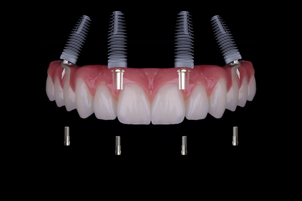 What To Know About Smile Restoration With All On   Dental Implants