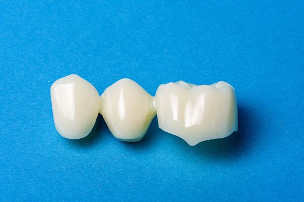 Are Dental Bridges Better Than Flipper Teeth?