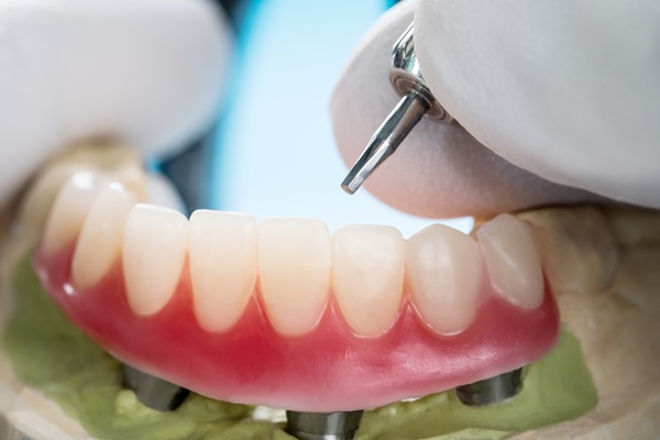 Implant Supported Dentures Vs  Traditional Dentures